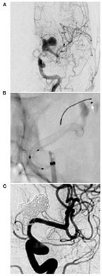 Flow Diversion for Intracranial Aneurysms Beyond the Circle of Willis